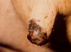 Ruptured lesion with necrosis on cow teat.