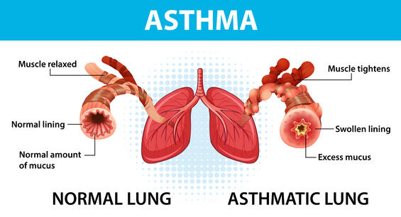 Graphic showing asthmatic lungs versus normal lungs. Details on webpage.